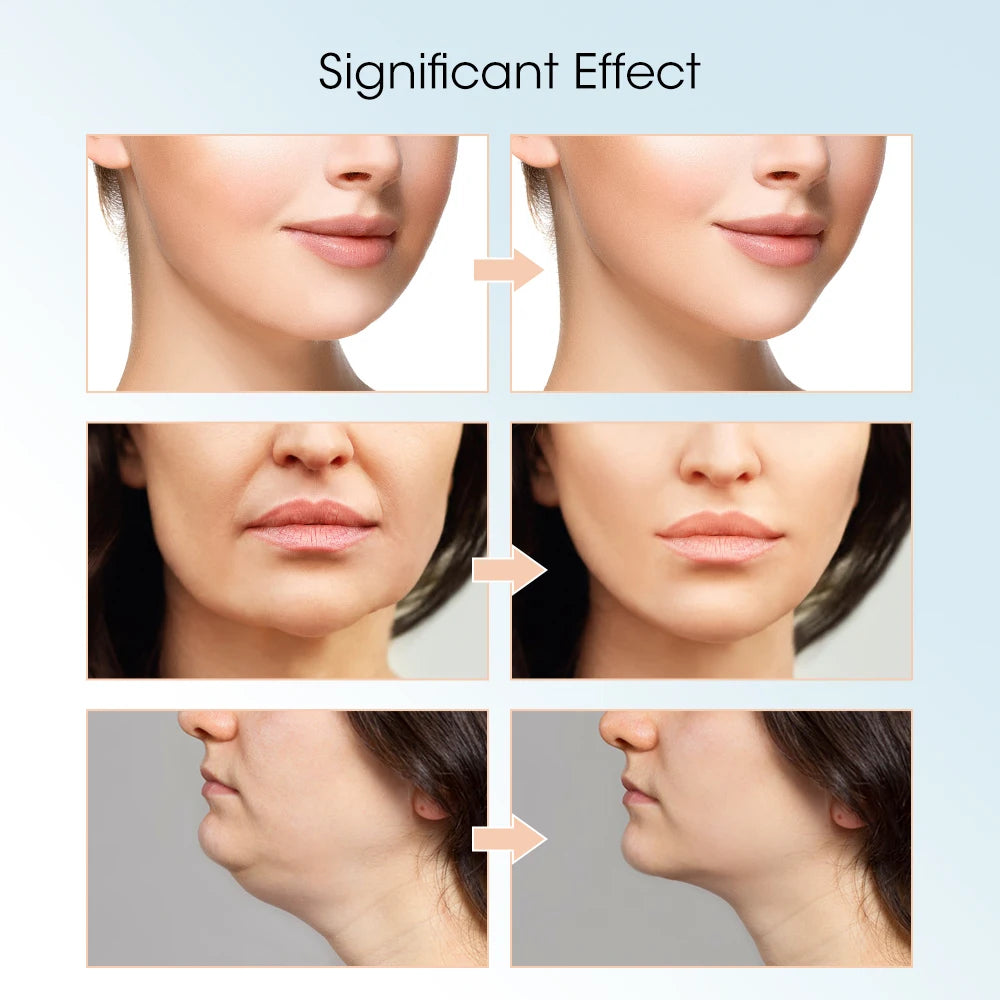 V-Shape Double Chin Reducer